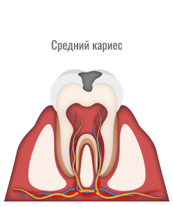 Средний кариес