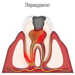 Пульпит